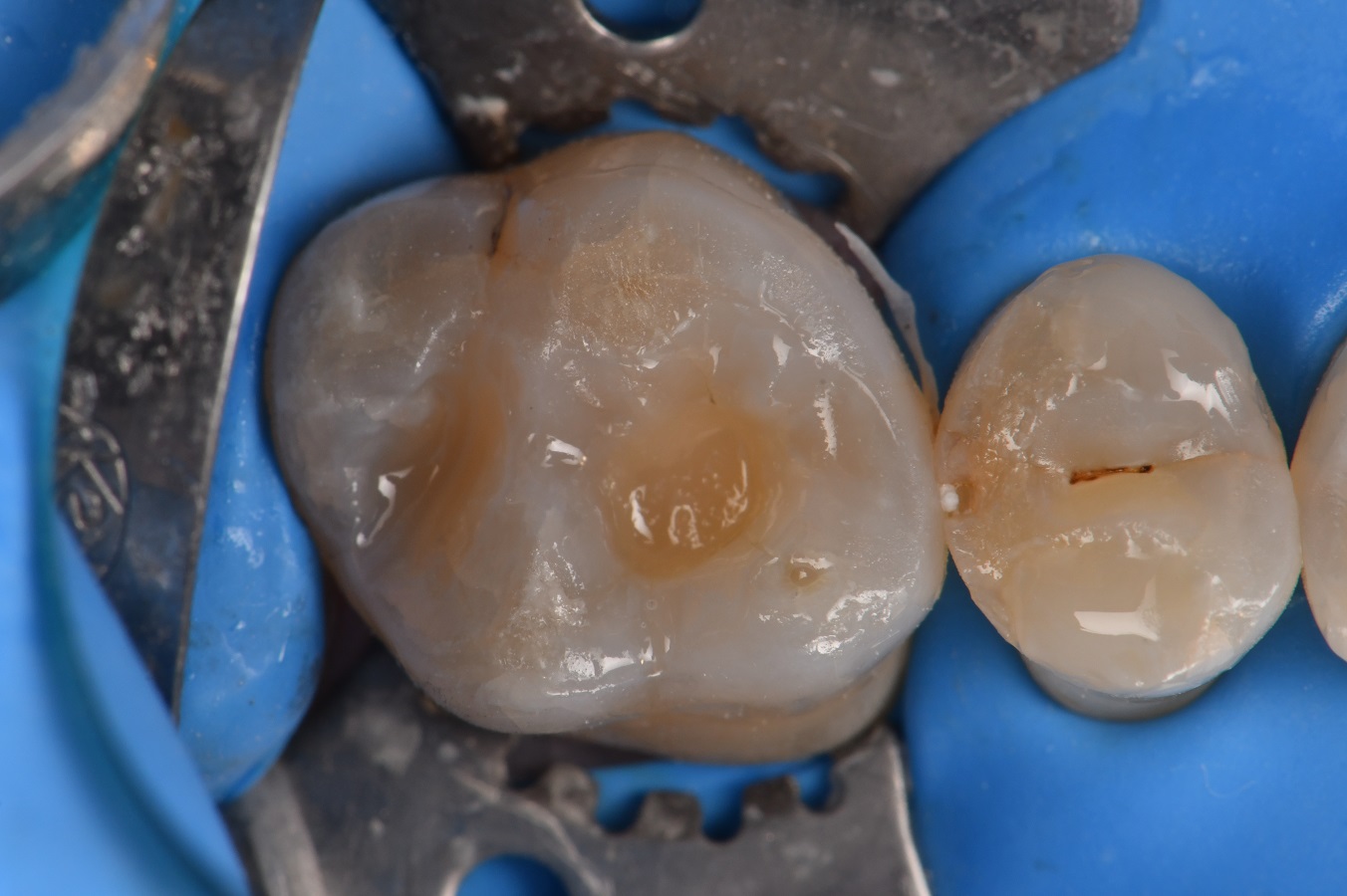 Class I dental cavity intricate anatomy