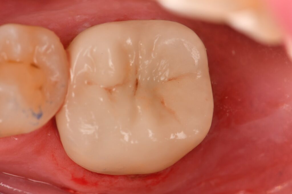 Cracks from Amalgam Restorations
