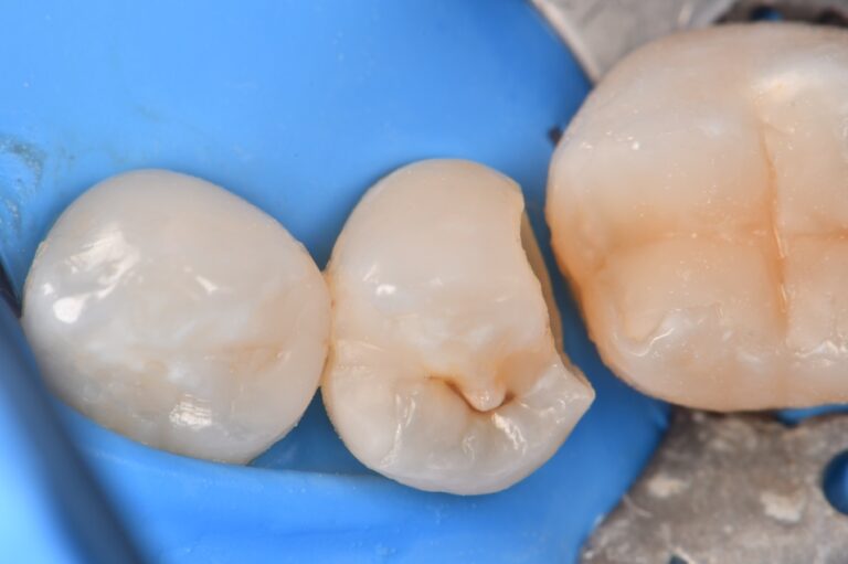 Over Eruption Overerupted Premolar Restorative Tips