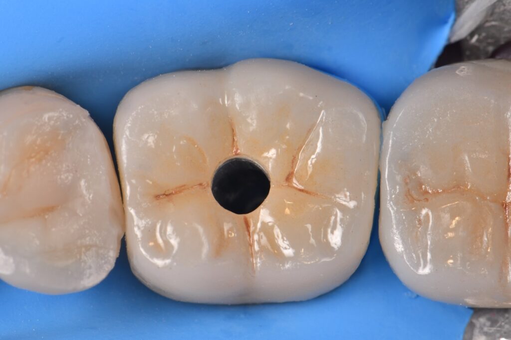 Implant Screw Access closure with Voco Amaris