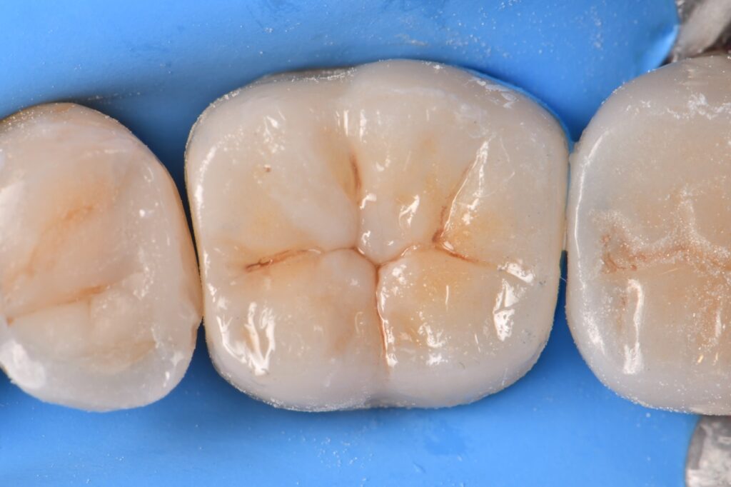 Implant Screw Access closure with Voco Amaris