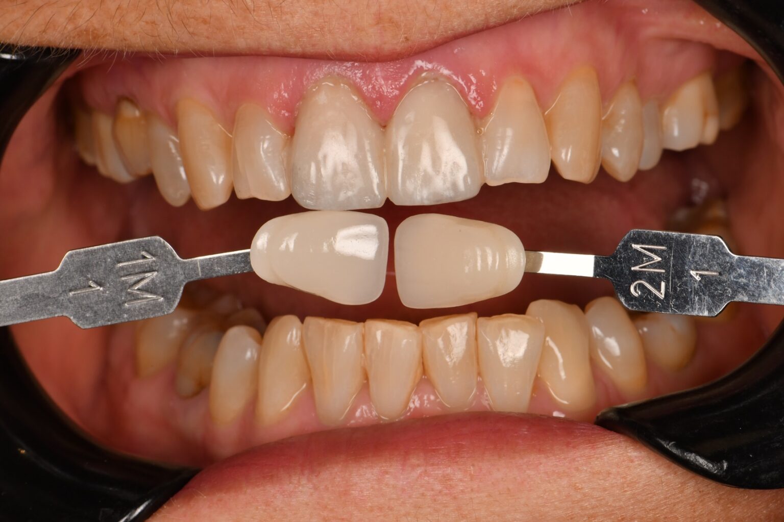 GC TempSmart Provisional Veneers Characterized using Optiglaze Color