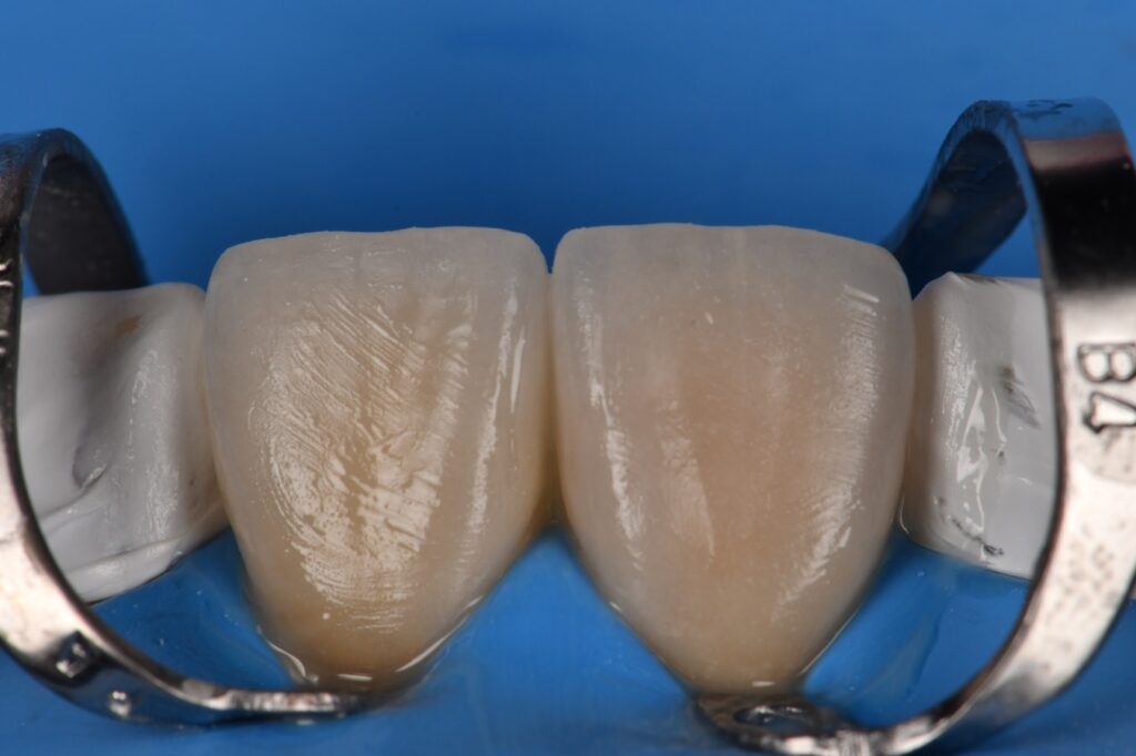 Nictone rubber dam absolute isolation with Variolink Esthetic