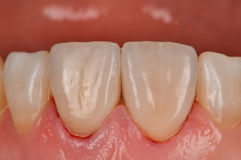 Nictone rubber dam absolute isolation with Variolink Esthetic