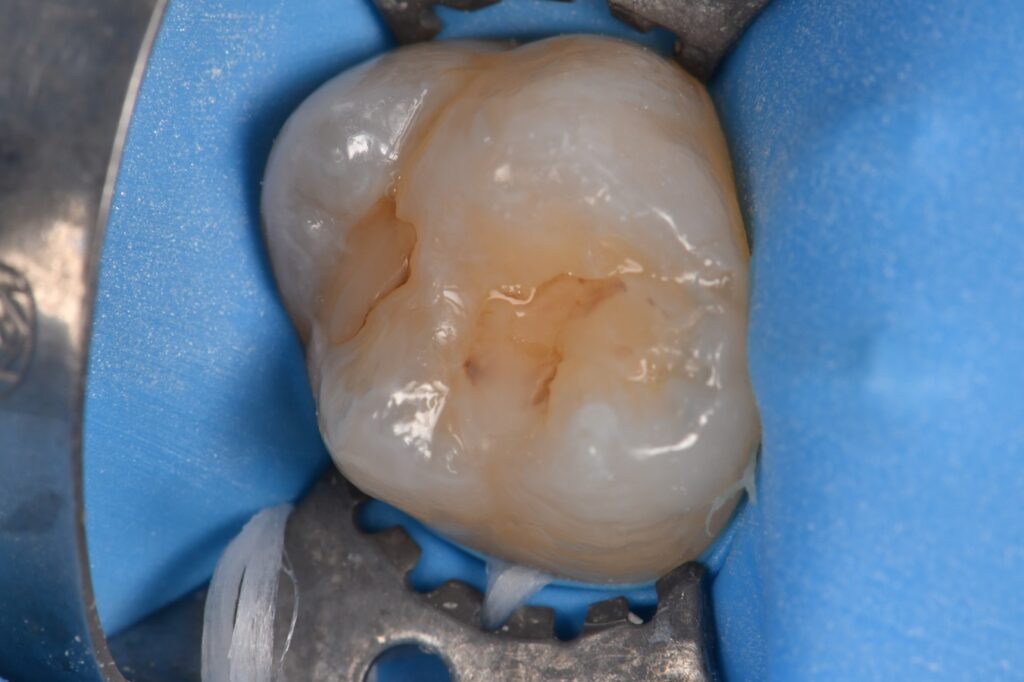 Supercomposite used in a Class I restoration replacement
