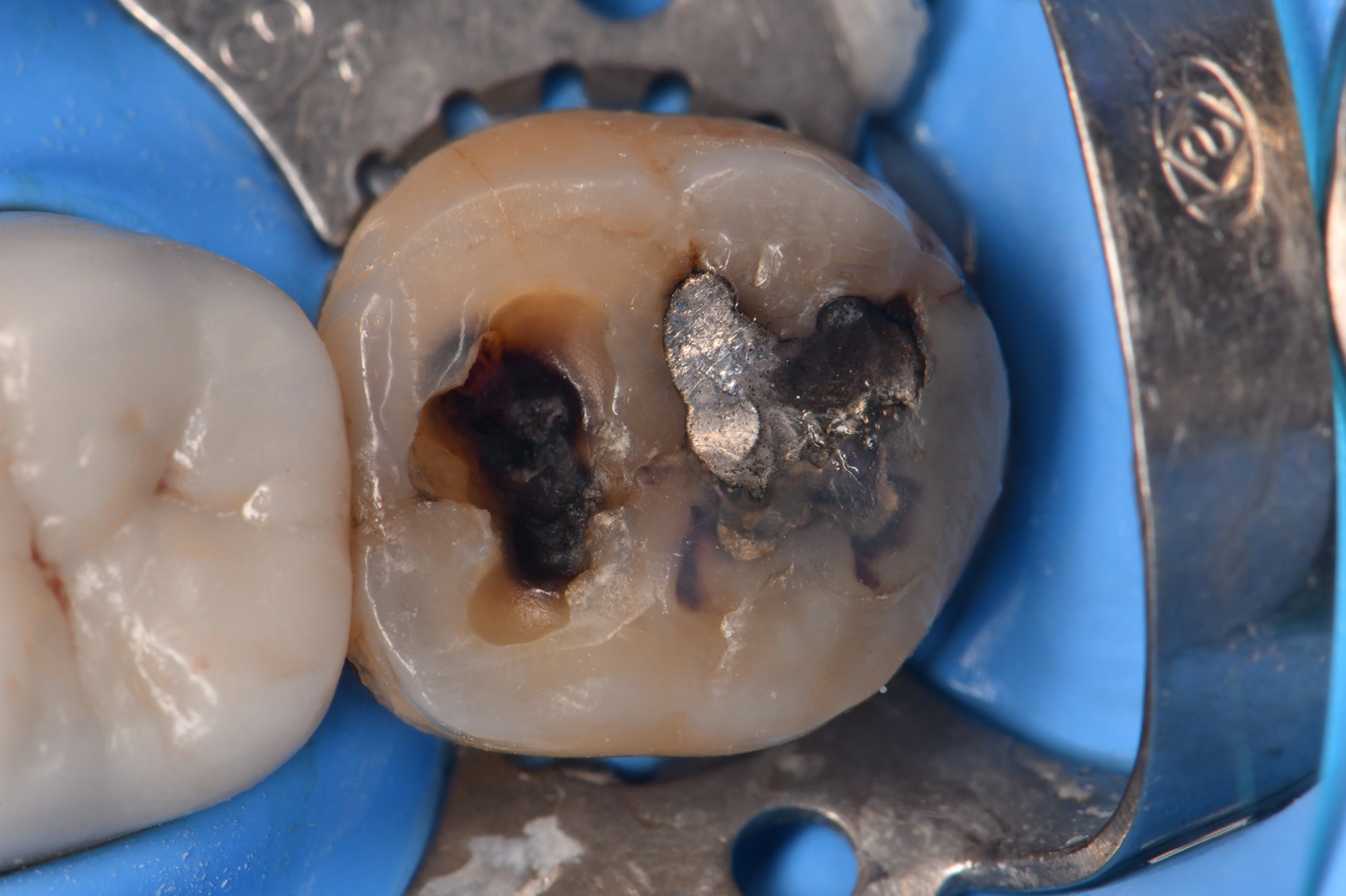 Large Class I Restoration with Amalgam removal