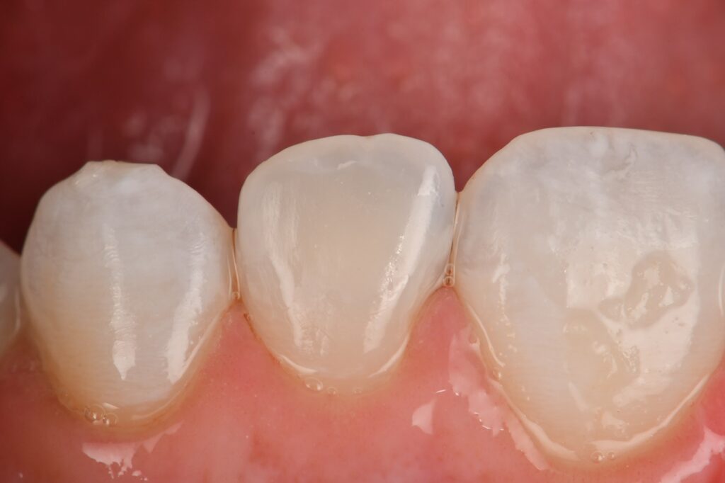 DMG Resin Infiltration used on a moderate hypomin case