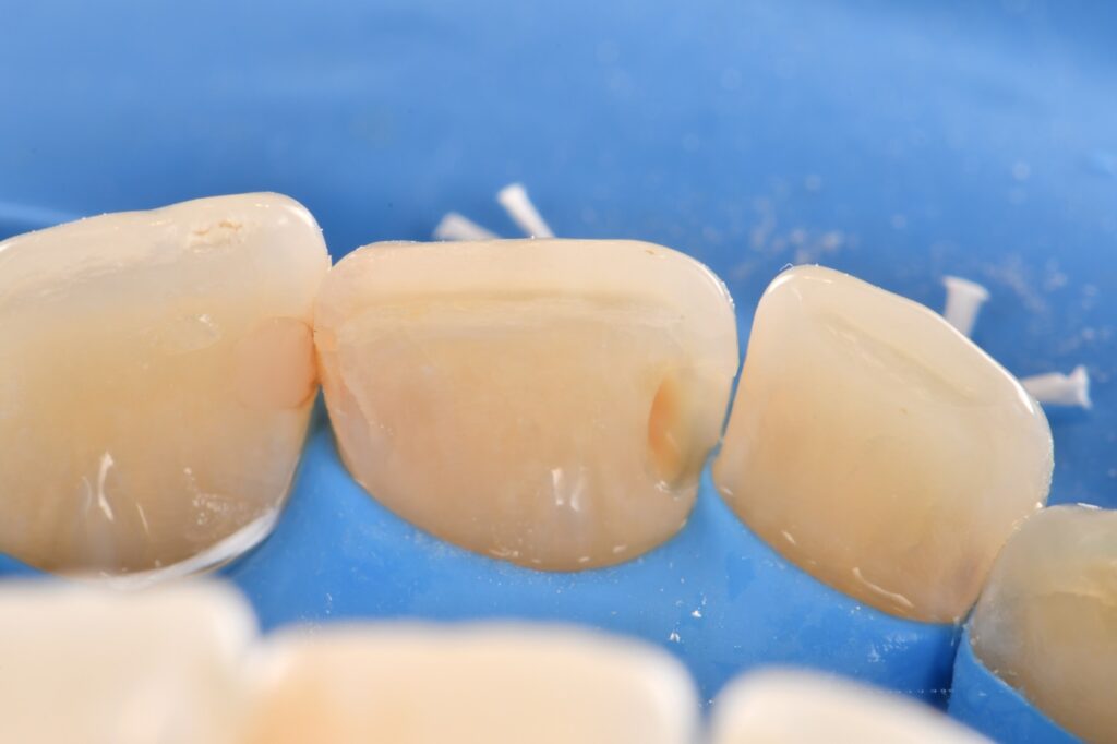 Supercomposite placed under absolute isolation