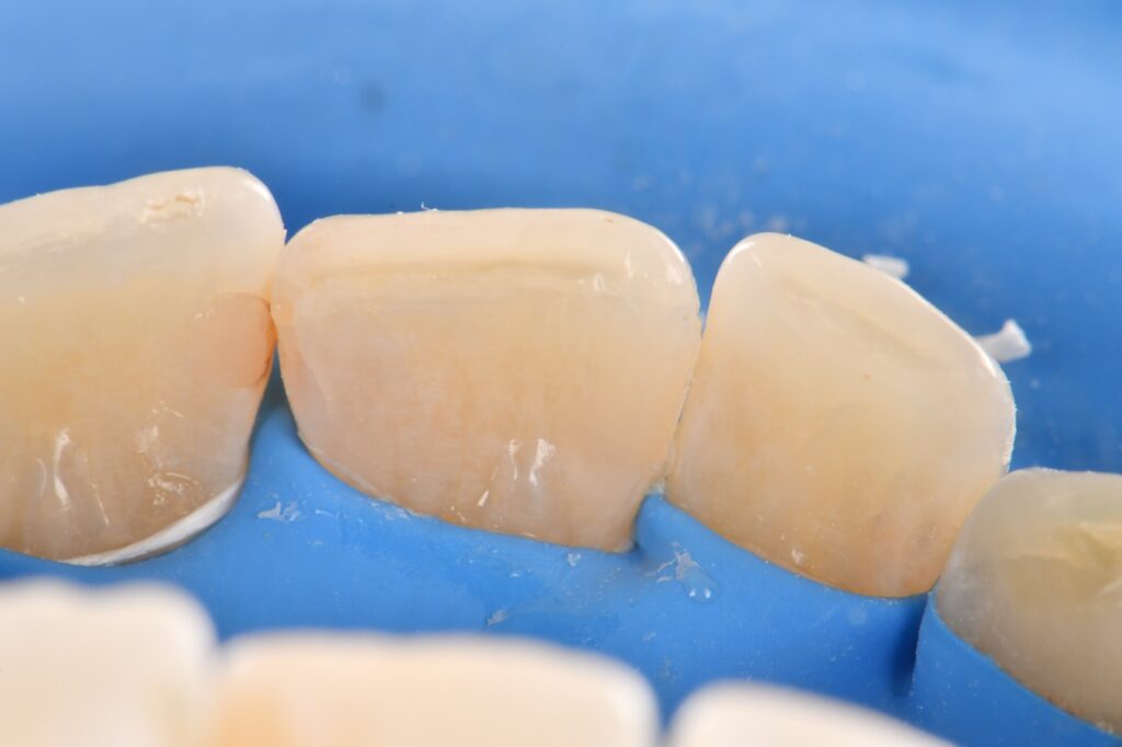 Supercomposite placed under absolute isolation