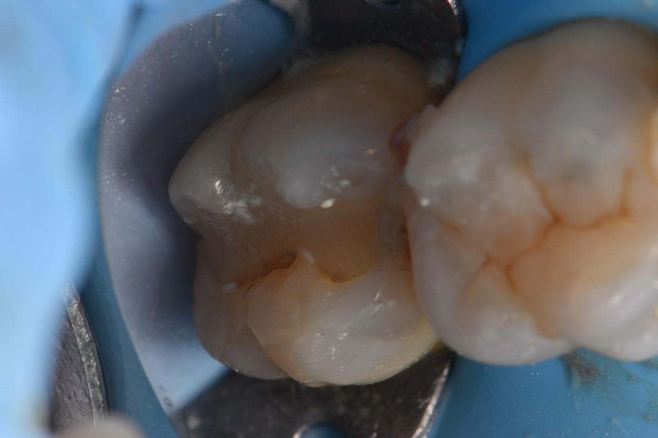 Class I restoration replacement on tooth #15