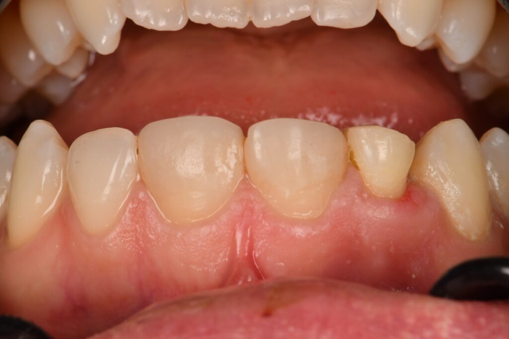 Orthodontic extrusion and crown lengthening to repair a fractured tooth