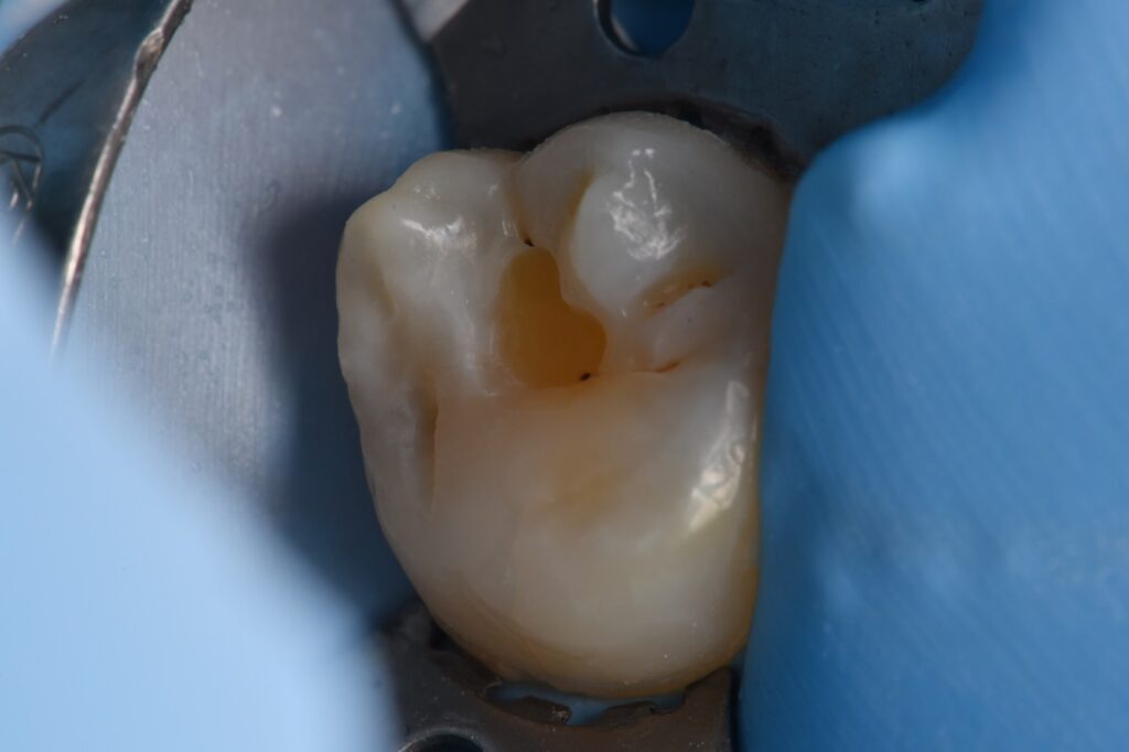 Supercomposite Class I on a second molar