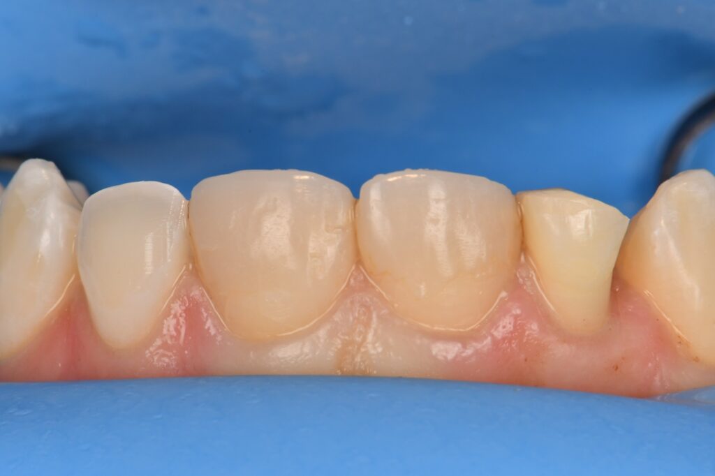 Orthodontic extrusion and crown lengthening to repair a fractured tooth