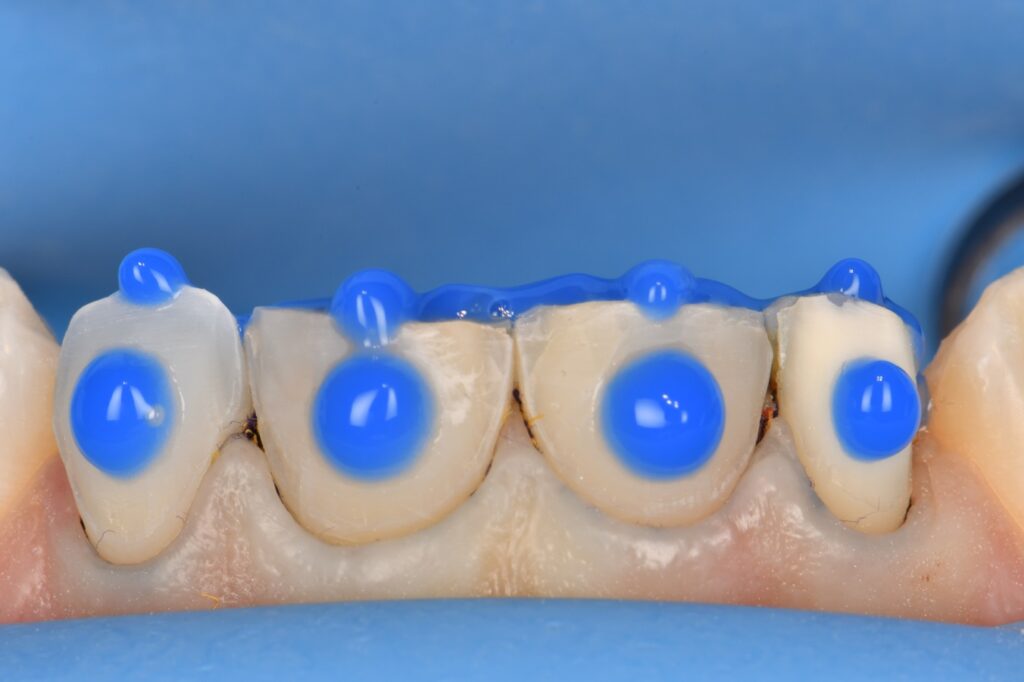 Orthodontic extrusion and crown lengthening to repair a fractured tooth