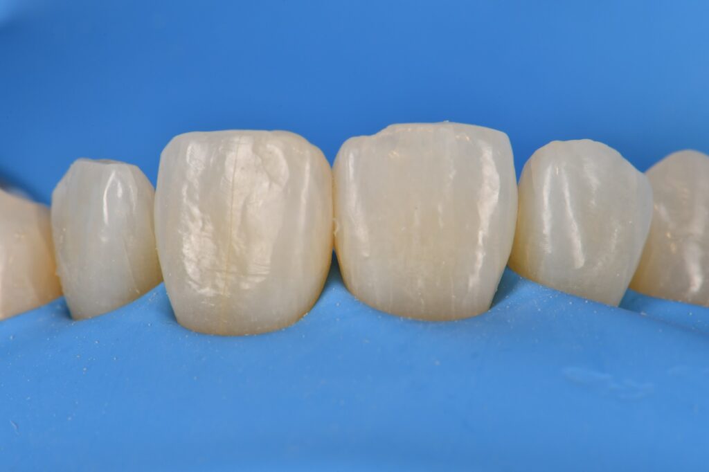 Voco Muar Voco Amaris used in Restorative Orthodontics
