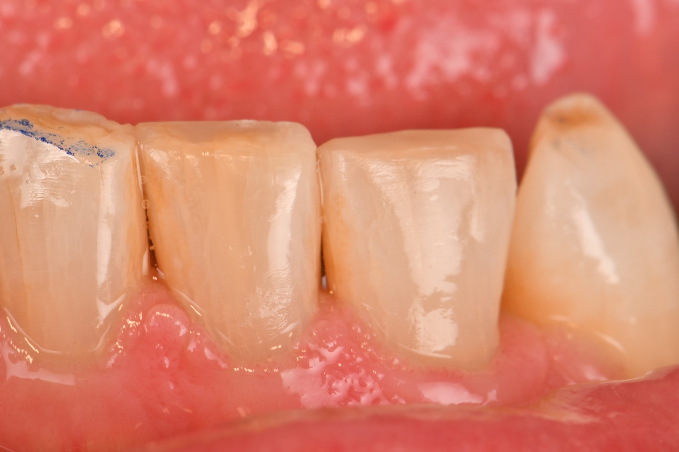 Enamel Crack Stabilization