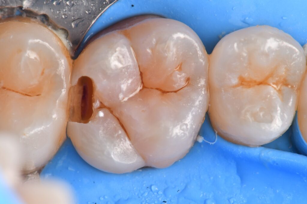 Re-creation of a marginal ridge using Clearfil Majesty