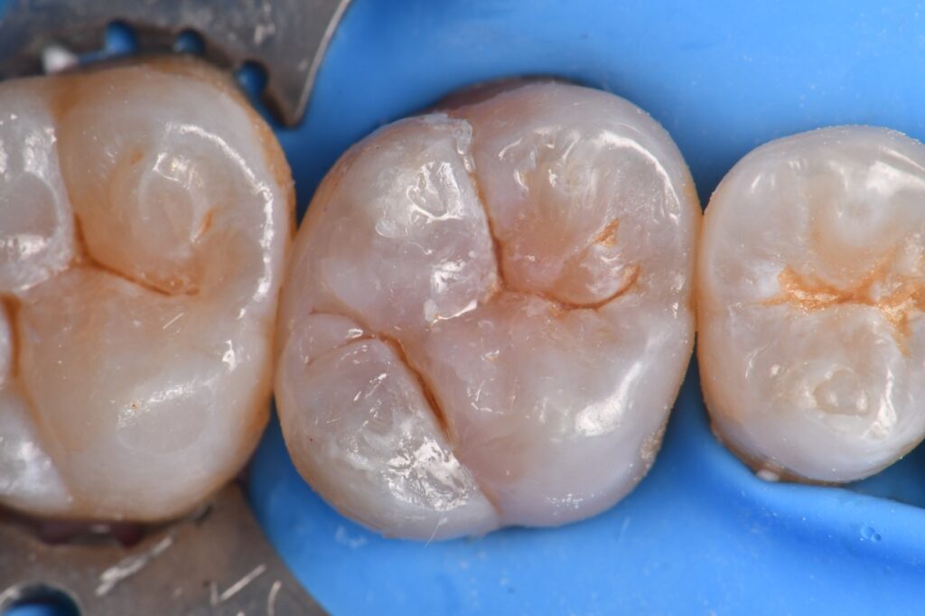 Re-creation of a marginal ridge using Clearfil Majesty