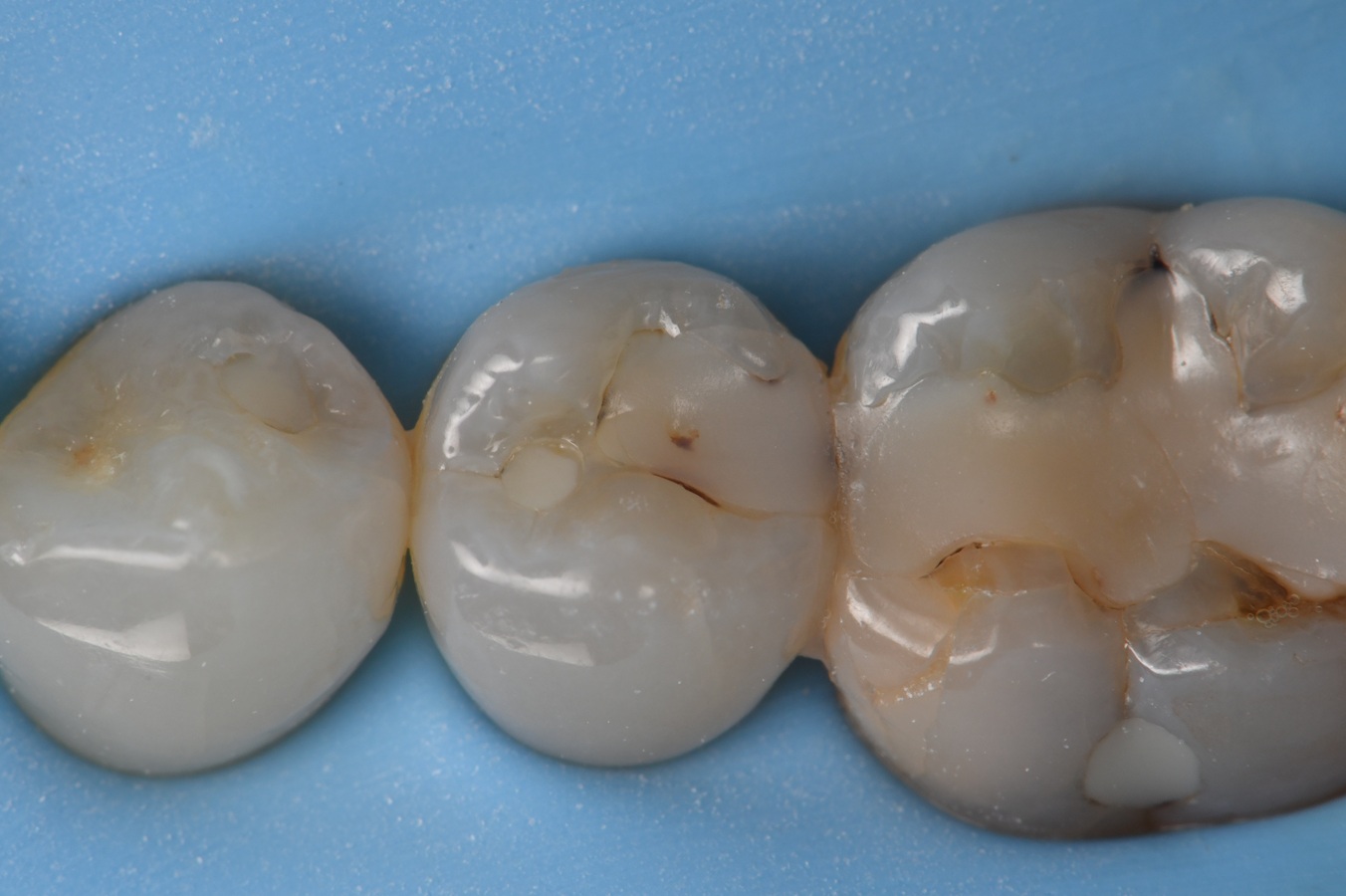 Mod Class Ii Composite Radiograph Class II restoration invisibility with composite resin