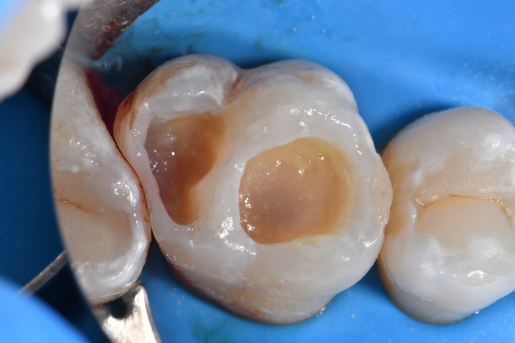 Omnimatrix used in Class II situations with root proximity