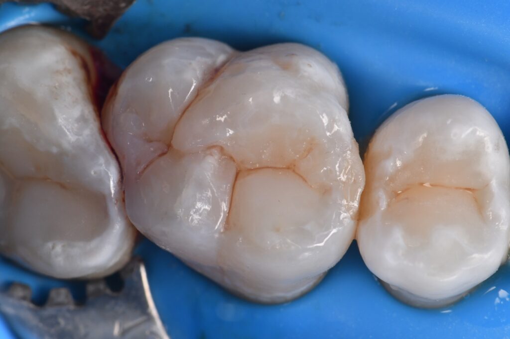 Omnimatrix used in Class II situations with root proximity