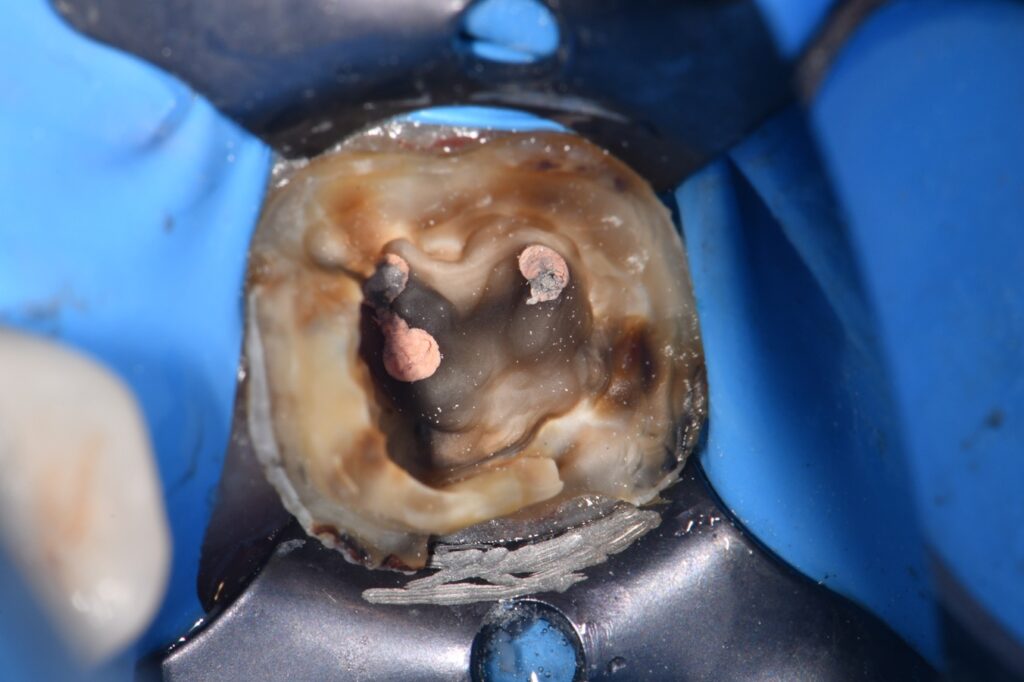 Core reconstruction under an old crown using Rebilda DC Fluorescent