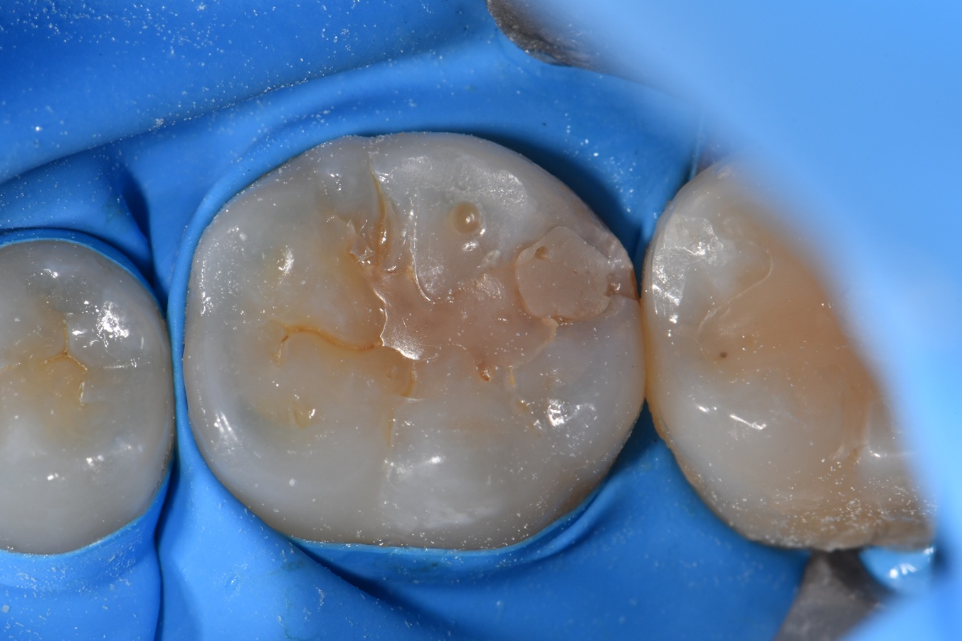Peripheral rim fracture and secondary caries