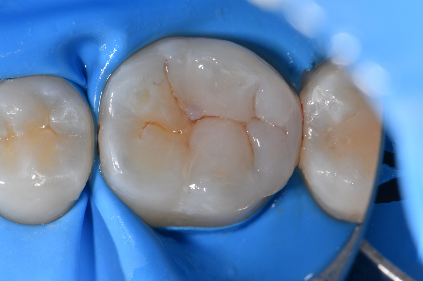 Peripheral rim fracture and secondary caries