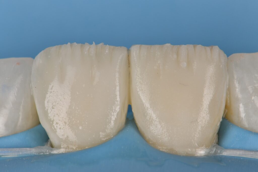 Voco Amaris Composite Veneers