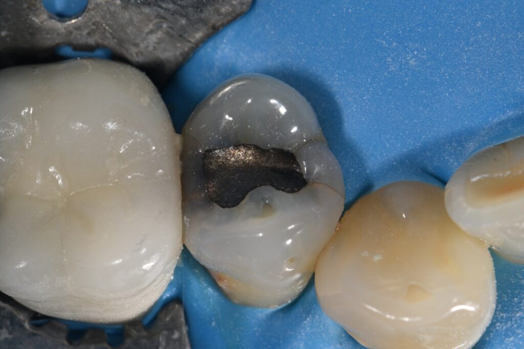Peripheral Rim Fracture Considerations in Cavity Design