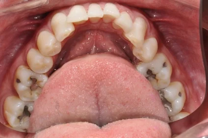 invisalign